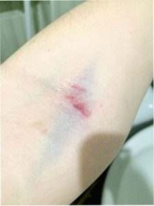 Side Effects of Donating Plasma 5