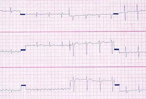 Cómo los niveles de azúcar en la sangre afectan tu cuerpo 9