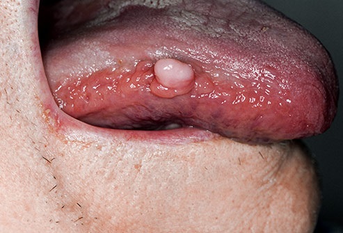 Lo que dice tu lengua sobre tu salud 12