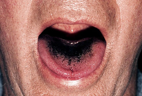 Lo que dice tu lengua sobre tu salud 4