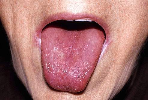 Lo que dice tu lengua sobre tu salud 7