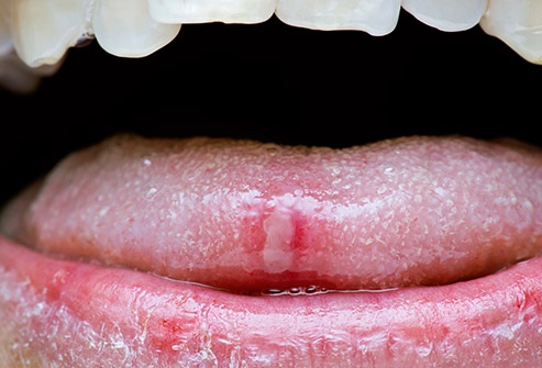 Lo que dice tu lengua sobre tu salud 8