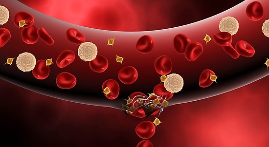 Evitar la aterosclerosis 4