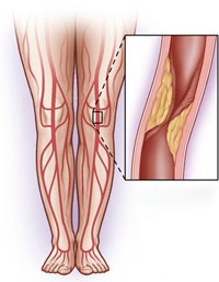 Healthy habits help people sidestep clogged leg arteries 2