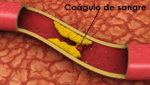 Healthy habits help people sidestep clogged leg arteries 3