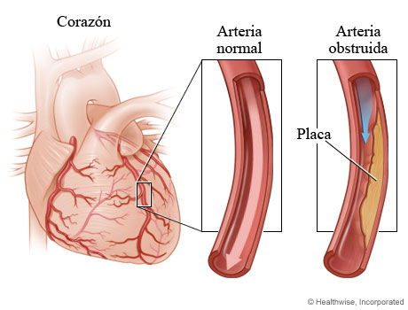 Un tipo diferente de ataque al corazón 3
