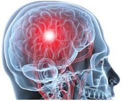 migraña hemipléjica 2