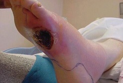 como afecta la diabetes sus pies 12