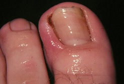 como afecta la diabetes sus pies 14