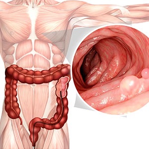 Existe un límite de edad para una colonoscopia 2.jpg