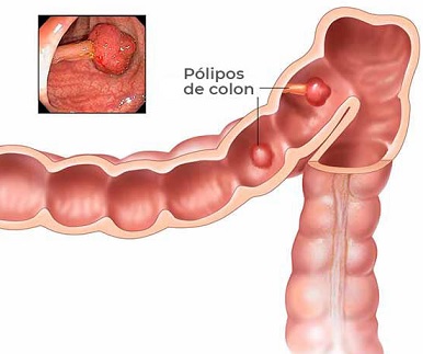 Existe un límite de edad para una colonoscopia 4.jpg