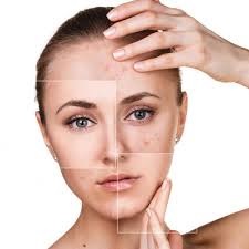 Why am I getting acne after menopause 2.jpg