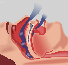Obesidad asociada a 60 comorbilidades 3.png