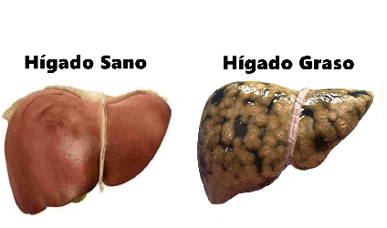 Obesidad asociada a 60 comorbilidades 7.png