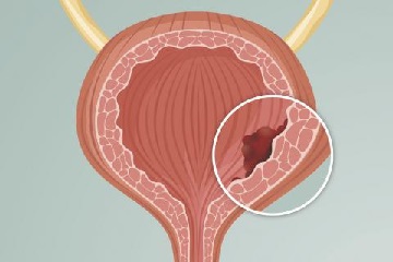 No dices Puede estallar su vejiga por aguantarla demasiado tiempo 3.jpg