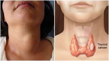 Se sobrediagnostica a las mujeres con cáncer de tiroides 3.jpg