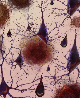 Por qué las mujeres son más propensas a desarrollar la enfermedad de Alzheimer 8.jpg
