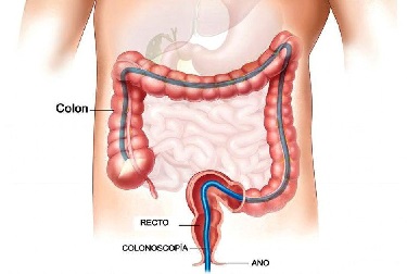 Decisiones sobre pruebas diagnósticas del cáncer de colon 3