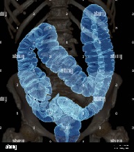 Decisiones sobre pruebas diagnósticas del cáncer de colon 7.jpg