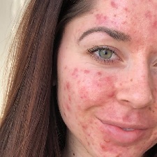 Acné en la mujer adulta Por qué se produce y la carga emocional 3.jpg