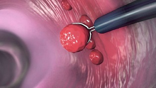 Las mujeres que se someten a un cribado más temprano tienen menos probabilidades de desarrollar cáncer colorrectal 2.jpg