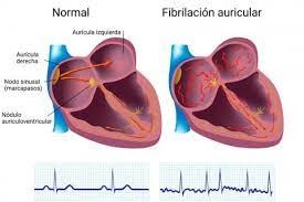 Pueden la ira y la depresión aumentar el riesgo de fibrilación auricular 3.jpg