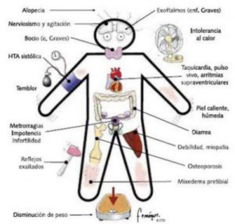 Basicamente las Patologias (Enfermedades) de la Tiroides son 2.jpg