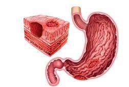 Cardiopatías y acidez estomacal Cuál es la coincidencia 6.jpg