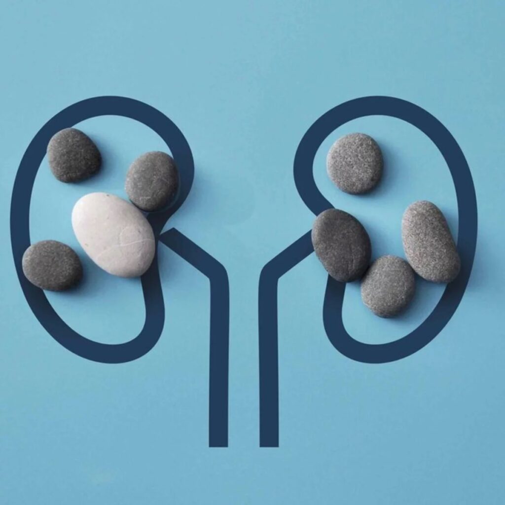 Se pueden prevenir las PIEDRAS (Litiasis, Calculos) en riñón | Doctor ...