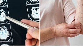 4 El herpes zóster, asociado a un mayor riesgo de cardiopatía e accidente cerebrovascular.jpg