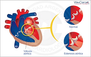 2 Opciones de reemplazo de la válvula aórtica.jpg