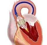 4 Opciones de reemplazo de la válvula aórtica.jpg