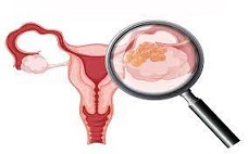 2 Prevención del cáncer de ovario Deberían las mujeres plantearse la extirpación de las trompas de Falopio.jpg