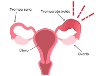 3 Prevención del cáncer de ovario Deberían las mujeres plantearse la extirpación de las trompas de Falopio.jpg