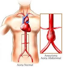 4 Concienciación sobre la enfermedad aórtica.jpg