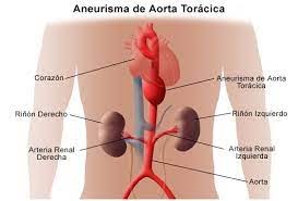 6 Concienciación sobre la enfermedad aórtica.jpg