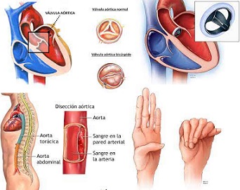 9 Concienciación sobre la enfermedad aórtica.jpg