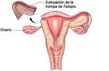 9 Prevención del cáncer de ovario Deberían las mujeres plantearse la extirpación de las trompas de Falopio.jpg
