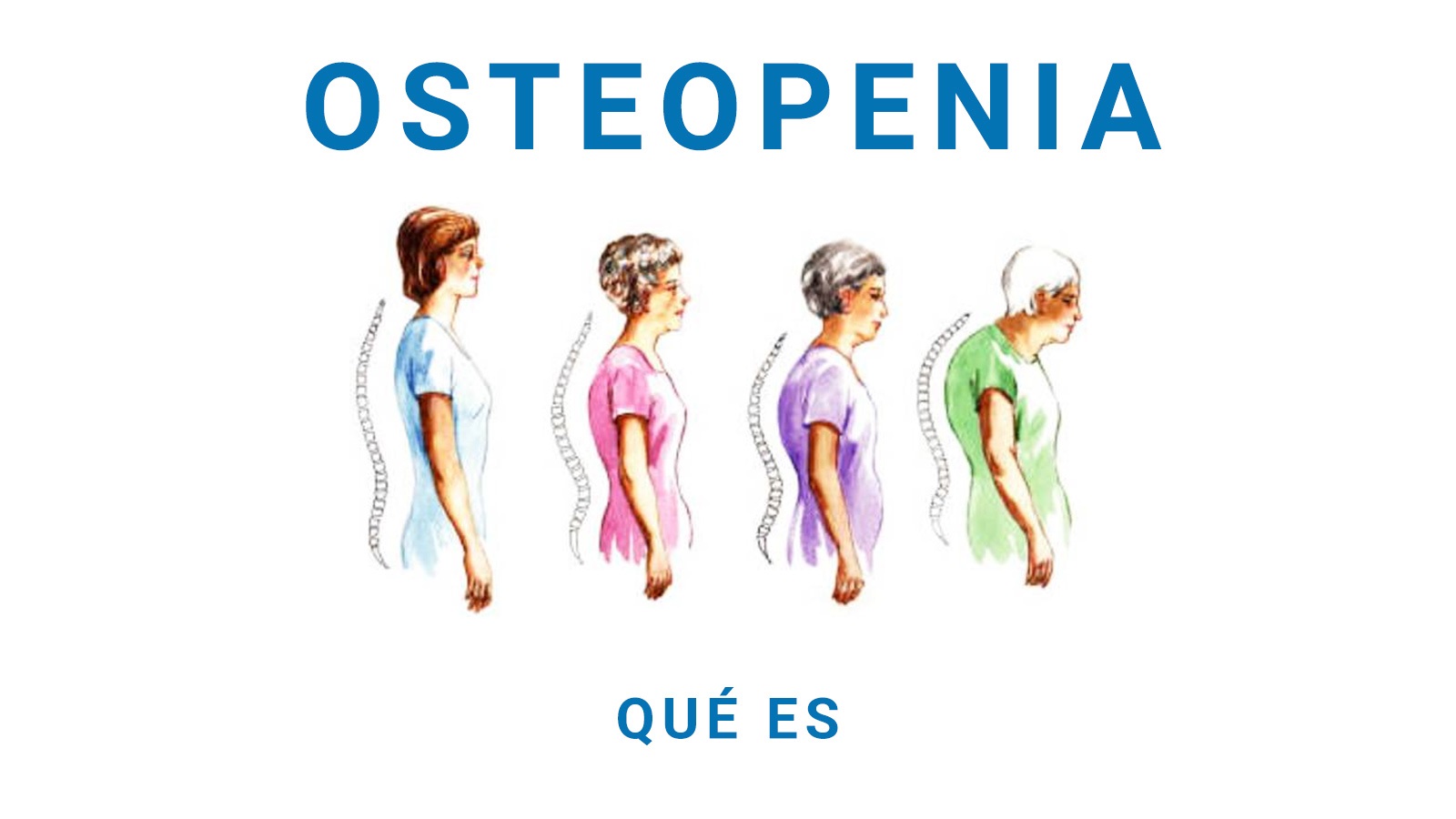 ¿Cuál es la diferencia entre osteoporosis y osteopenia? - Doctor ...